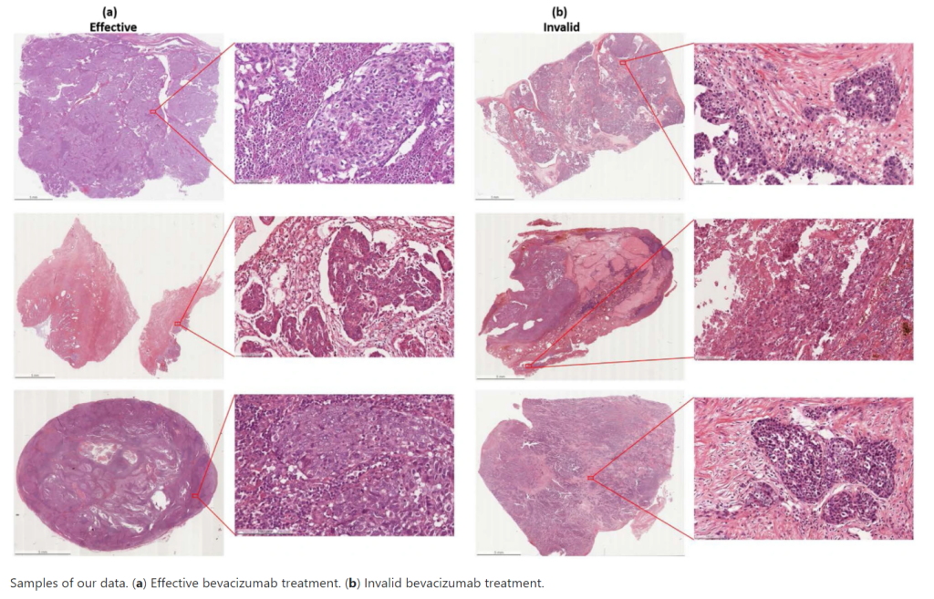 OVARIAN BEVACIZUMAB RESPONSE The Cancer Imaging Archive TCIA