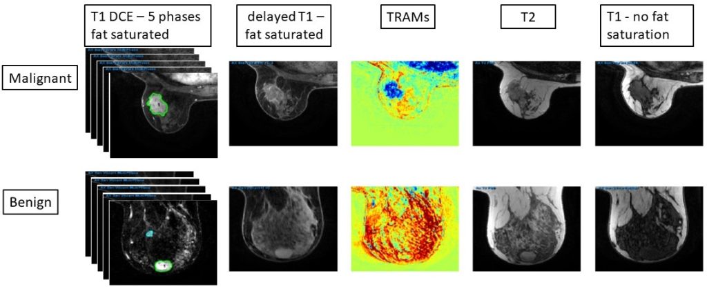 Advanced-MRI-Breast-Lesions_collection1_cropped - The Cancer Imaging ...