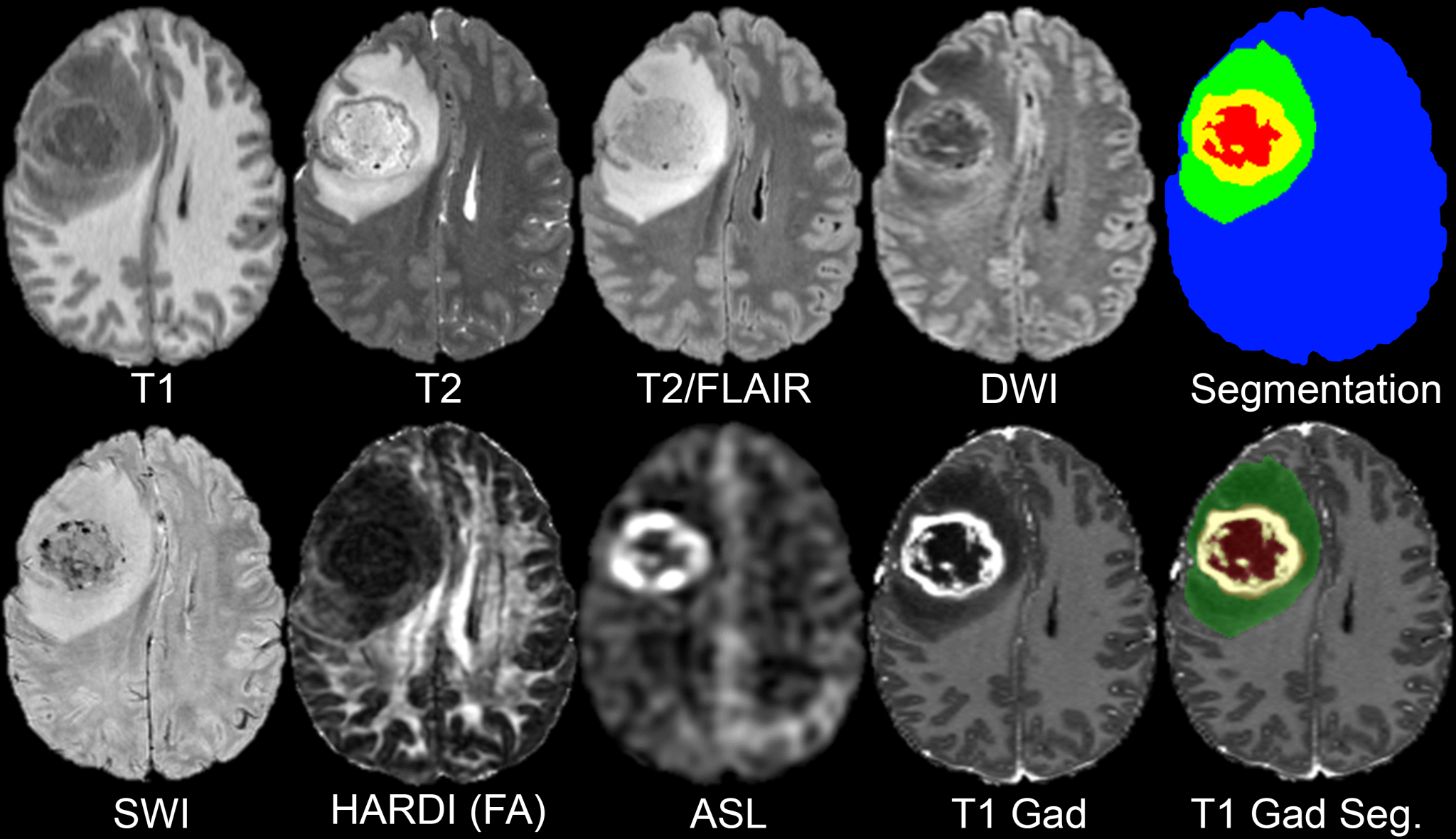 cancer imaging archive dataset